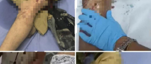 عاجل.. إصابات بين محتجين إثر إطلاق نار قوات الاحتلال اليمني على بوابة معاشيق في عدن (صور)