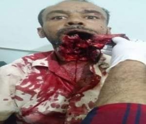 بن بريك : ما يجري في تعز دليل على فاشية الإصلاح.. ويناشد التحالف التدخل