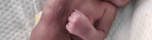 حالة نادرة.. ولادة طفل برجل واحدة في أحد مشافي عتق (صور)