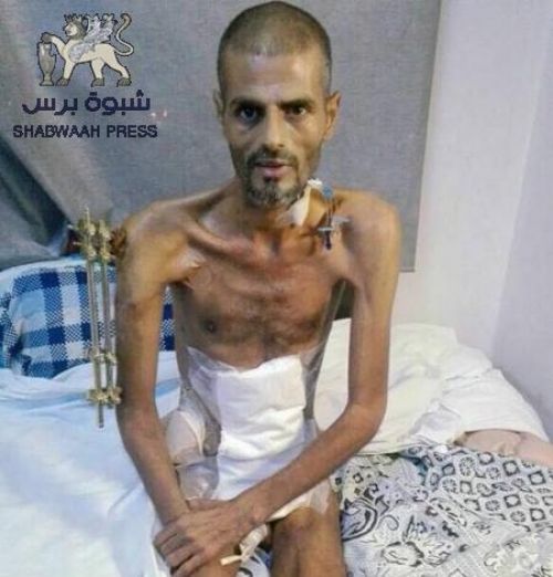 علاج جرحى المقاومة الجنوبية مسئولية "التحالف العربي" أخلاقيا 