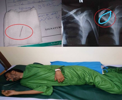 دق المسامير في أجساد المعتقلين السياسيين أسلوب جديد للتعذيب تمارسه مليشيات الإخونج في شبوه 
