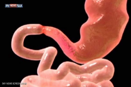 نصائح لمريض القرحة الهضمية في رمضان (صور)