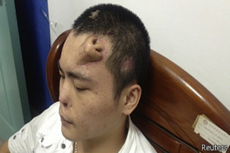 زراعة أنف في جبهة مريض تمهيدا لوضعه محل أنفه الأصلي