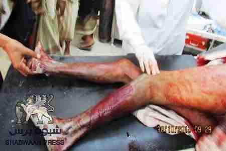 منع الأمن اليمني اسعاف الجريحان صوابان وحرسي في عتق جريمة حرب (صور)