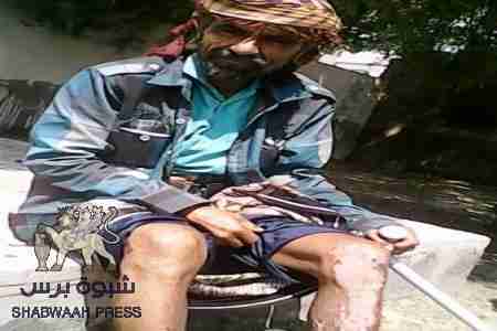 جريح العسكرية المشوشي : اهملت من الحراك ونشطاء واعلام نسوا الامي