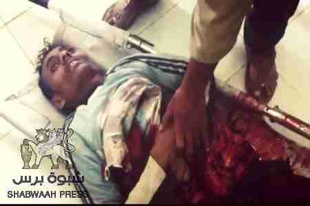 قتيلان وعشرات الجرحى نتيجة قصف قوات الاحتلال لمدن بالضالع