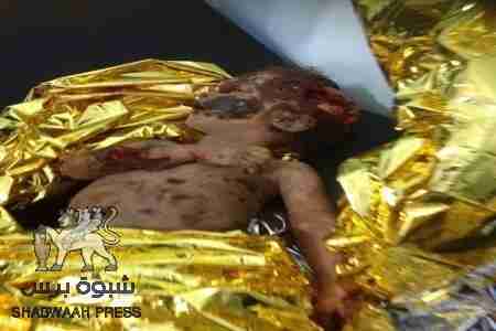 استشهاد طفلين اثر انفجر لغم من مخلفات 1994م في جول مدرم كرش