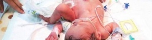 بالصور..وصول «السياميين اليمنيين» عبدالعزيز وعبدالله لمدينة الملك فهد الطبية