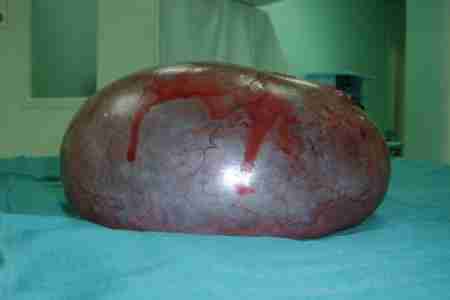 فريق طبي عدني ينجح في استئصال كيس صديدي من جمجمة إمرأة بعدن