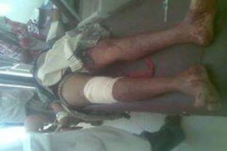 انفجار قنبلة في يافع تتسبب في اصابات