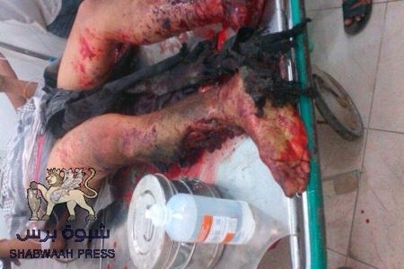 عنصرية جنوبية مقيته ونفاق بغيض ... ازدواجية الحراك بين ساقي زهرة ومعاذ