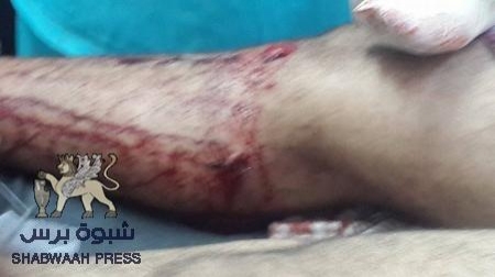 اصابة ثلاثة من أبناء الباجمال في غارة عتق يوم أمس وأضرار جانبية أخرى(صور)