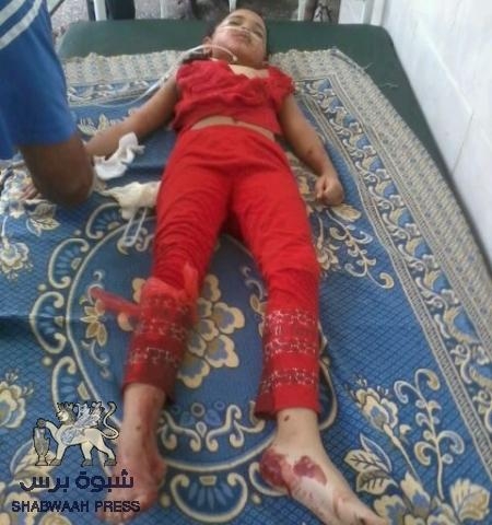 سقوط طفلة وشخص آخر بالمعلا برصاص قناصة حوثيين