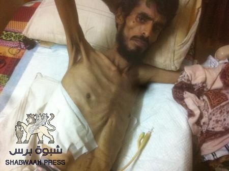 صورة مرعبة : الاهمال واللآمبالاة تجاه الجرحى الجنوبيين من قبل حكومة الشرعية تسبب في مآسي وكوارث للمقاتلين