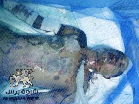 بلاغ .. لله ثم للجرحى بلغوه للرئيس هادي (صور جرحى)