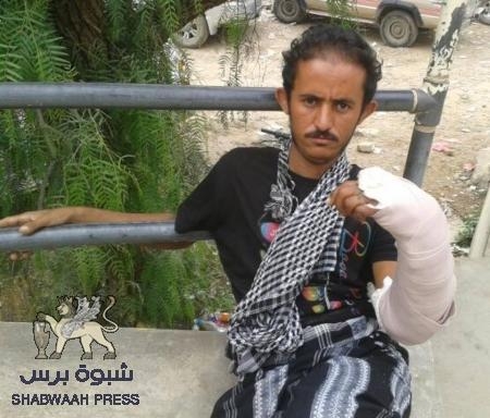 الجريح المقاوم ماجد شعفل الردفاني يبعث بمناشدة عاجلة لانقاذ يده من البتر