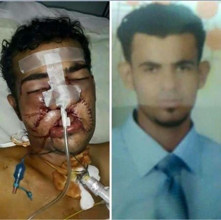 أبطال الجنوب الجرحى يواجهون الجحود والخذلان من حكومة اليمن