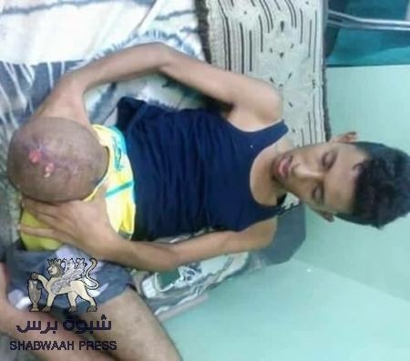 لم تكتب له الشهادة وفقد رجله .. ولم تعوضه حكومة الكفاءات برجل صناعية