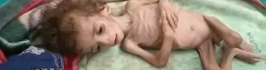 الفقر وسوء التغذية يفتك بأطفال أزارق الضالع (صور موجعه)