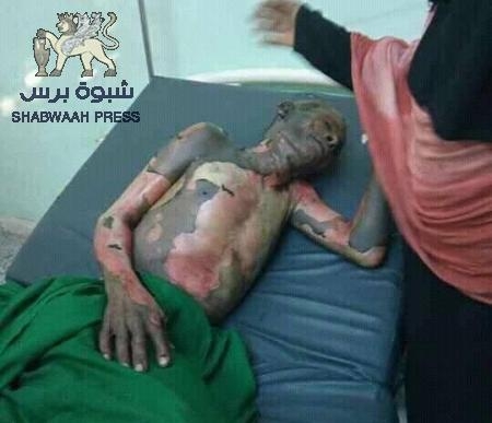 مواطن من محافظة ‘‘هادي‘‘ يحرق نفسه لعجزه عن إطعام أطفاله الخمسة (صورة موجعة)