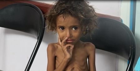 وفاة "زهرة" طفلة وجبات أوراق الشجر بعد صراع مع الجوع في اليمن