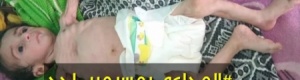 ‘‘شبوه برس‘‘ يدق ناقوس ...خطر المجاعه بمسيمير لحج يفتك بالأطفال (صور)